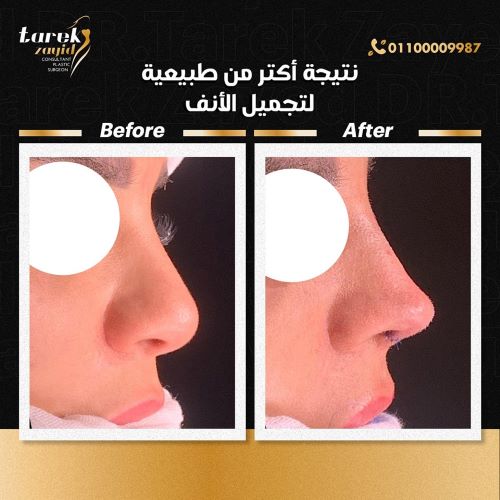 افضل دكتور تجميل انف في مصر 2026